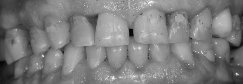 Schwer geschädigte Frontzähne und vorgeschädigtes entzündetes Zahnfleisch