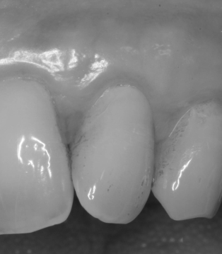Ein Jahr nach Rezessionsdeckung: Zahnhälse sind stabil von Zahnfleisch bedeckt