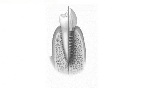 Im Querschnitt: Zahn und Implantat mit Keramikkrone.