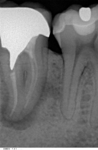 Linker Zahn mit typischer dunkler Knochenentzündungs Zone an der Wurzelspitze