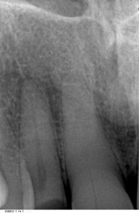 Am rechten Zahn sieht man eine einzige homogene Wurzelmasse, der linke Zahn weist noch einenkleine dunklen inneren Raum ( Pulpa) auf